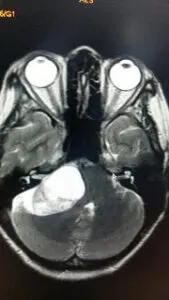 Large Acoustic Schwannoma operated by Dr Vineet Saggar Neurosurgeon mohali chandigarh punjab