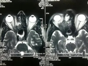 Rare Intra Orbital Tumour Operated via Supra Orbital Craniotomy Approach. Chandigarh Mohali & Punjab