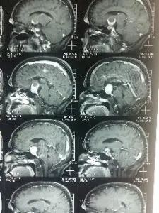 TRANSSPHENOIDAL REMOVAL OF PITUTARY MACRO ADENOMA