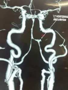 Rare vertebral artery - pica jn aneurysm operated by us at Livasa hospital mohali with good outcome
