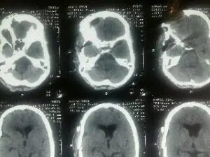 RARE M2-M3 JUNCTION ANEURYSM OPERATED AT Livasa HOSPITAL MOHALI BY DR VINEET SAGGAR