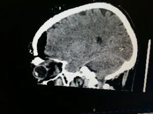 Rare Intra Orbital Tumour Operated via Supra Orbital Approach