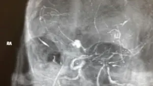 Rare LENTICULOSTRIATE ARTERY aneurysm operated by Dr Vineet Saggar