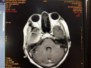 LARGE TEMPORAL MASS OPERATED AT Livasa HOSPITAL