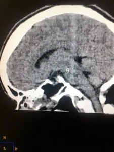 SKULL BASE NEUROSURGERY INDIA - Dr Vineet Saggar