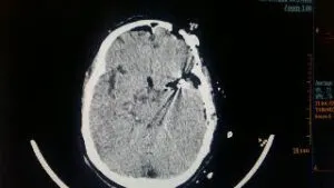 Large wide necked MCA BIFURCATION ANEURYSM operated by us at Livasa hospital mohali chandigarh punjab with good outcome