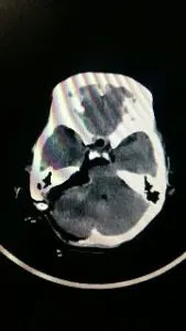 Large Acoustic Schwannoma operated by Dr Vineet Saggar Neurosurgeon mohali chandigarh punjab