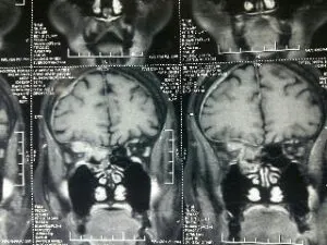 Rare Intra Orbital Tumour Operated via Supra Orbital Craniotomy Approach. Chandigarh Mohali & Punjab