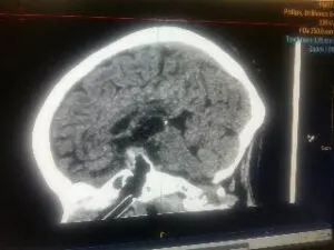 TRANSSPHENOIDAL REMOVAL OF PITUTARY MACRO ADENOMA