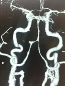 Rare vertebral artery - pica jn aneurysm operated by us at Livasa hospital mohali with good outcome