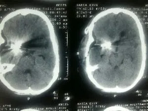 RARE M2-M3 JUNCTION ANEURYSM OPERATED AT Livasa HOSPITAL MOHALI BY DR VINEET SAGGAR