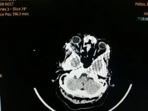 Rare Intra Orbital Tumour Operated via Supra Orbital Approach