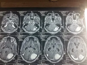LARGE POSTERIOR FOSSA MENINGIOMA OPERATED BY DR VINEET SAGGAR WITH EXCELLENT OUT COME