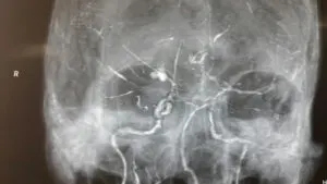 Rare LENTICULOSTRIATE ARTERY aneurysm operated by Dr Vineet Saggar