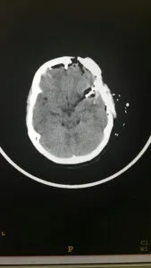 Giant Distal MCA ANEURYSM (M2-M3) junction aneurysm operated by us with good outcome at chandigarh mohali punjab