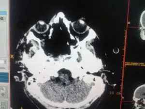 RARE SKULL BASE TUMOUR OPERATED AT Livasa HOSPITAL VIA OSTEOPLASTIC MAXILLOTOMY APPROACH