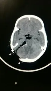 Large Acoustic Schwannoma operated by Dr Vineet Saggar Neurosurgeon mohali chandigarh punjab