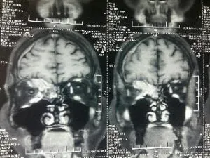 Rare Intra Orbital Tumour Operated via Supra Orbital Craniotomy Approach. Chandigarh Mohali & Punjab