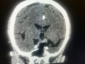 TRANSSPHENOIDAL REMOVAL OF PITUTARY MACRO ADENOMA