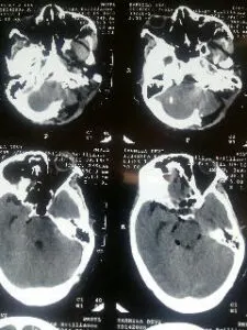 Rare vertebral artery - pica jn aneurysm operated by us at Livasa hospital mohali with good outcome