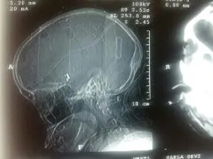 RARE M2-M3 JUNCTION ANEURYSM OPERATED AT Livasa HOSPITAL MOHALI BY DR VINEET SAGGAR
