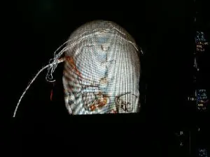 Rare Intra Orbital Tumour Operated via Supra Orbital Approach