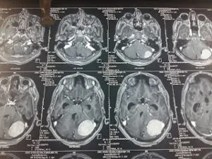 LARGE POSTERIOR FOSSA MENINGIOMA OPERATED BY DR VINEET SAGGAR WITH EXCELLENT OUT COME