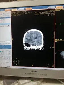 LARGE TEMPORAL MASS OPERATED AT Livasa HOSPITAL