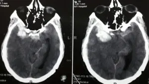 Rare Lenticulostriate Artery Aneurysm Operated by Dr Vineet Saggar