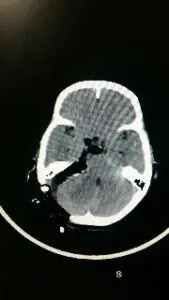 Large Acoustic Schwannoma operated by Dr Vineet Saggar Neurosurgeon mohali chandigarh punjab