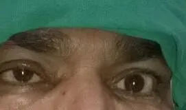 Rare Intra Orbital Tumour Operated via Supra Orbital Craniotomy Approach. Chandigarh Mohali & Punjab