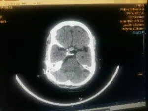 TRANSSPHENOIDAL REMOVAL OF PITUTARY MACRO ADENOMA