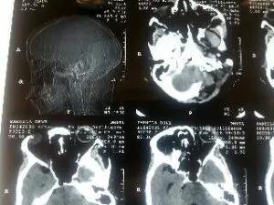 Rare vertebral artery - pica jn aneurysm operated by us at Livasa hospital mohali with good outcome
