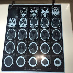 LARGE POSTERIOR FOSSA MENINGIOMA OPERATED BY DR VINEET SAGGAR WITH EXCELLENT OUT COME