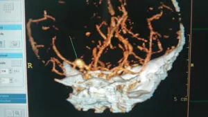 Rare LENTICULOSTRIATE ARTERY aneurysm operated by Dr Vineet Saggar