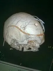 Rare Intra Orbital Tumour Operated via Supra Orbital Craniotomy Approach. Chandigarh Mohali & Punjab
