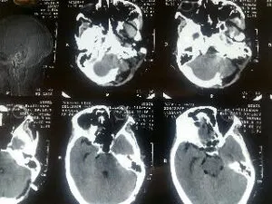 Rare vertebral artery - pica jn aneurysm operated by us at Livasa hospital mohali with good outcome