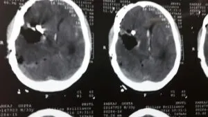 Rare LENTICULOSTRIATE ARTERY aneurysm operated by Dr Vineet Saggar