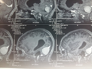 LARGE POSTERIOR FOSSA MENINGIOMA OPERATED BY DR VINEET SAGGAR WITH EXCELLENT OUT COME