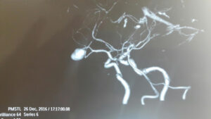 Giant Distal MCA ANEURYSM (M2-M3) junction aneurysm