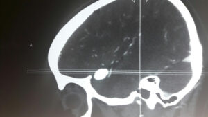 Giant Distal MCA ANEURYSM (M2-M3) junction aneurysm